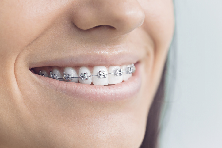 aparat ortodontyczny na zębach kobiety